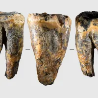 Neanderthals treated a dental cavity by drilling into the tooth