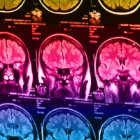 Higher body mass index in youth linked to altered brain connectivity