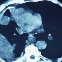 STAT+: Akeso and Summit’s ivonescimab extends survival in squamous cell lung cancer